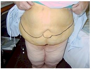 dermolipectomia_cirugia_bariatrica/lipectomia_abdomen_obesidad_morbida_2