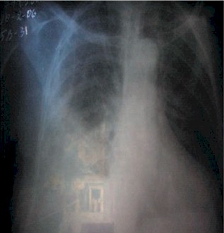 caso_clinico/empiema_radiografia_rx_2 caso_clinico/empiema_radiografia_rx_2