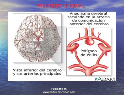enfermedad_cerebrovascular/ACV_aneurisma_cerebral enfermedad_cerebrovascular/ACV_aneurisma_cerebral