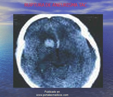 enfermedad_cerebrovascular/ACV_aneurisma_cerebral_roto