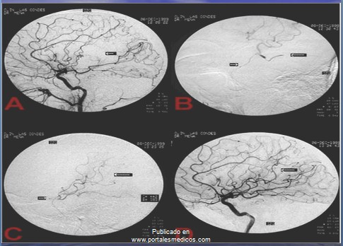 enfermedad_cerebrovascular/ACV_arteriografia enfermedad_cerebrovascular/ACV_arteriografia