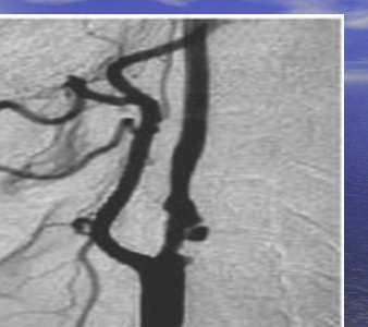 enfermedad_cerebrovascular/ACV_ateromatosis_carotida