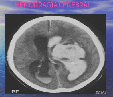 enfermedad_cerebrovascular/ACV_hemorragia_cerebral