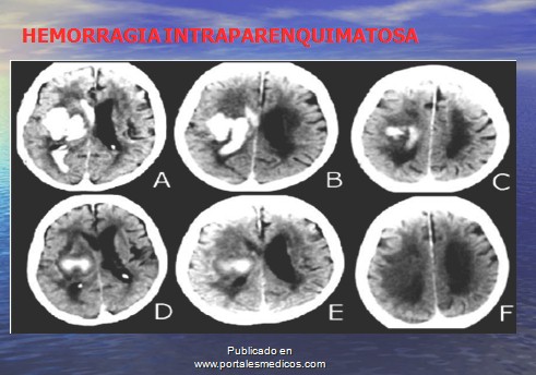 enfermedad_cerebrovascular/ACV_hemorragia_intraparenquimatosa