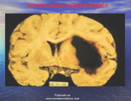 enfermedad_cerebrovascular/ACV_hemorragia_subaracnoidea