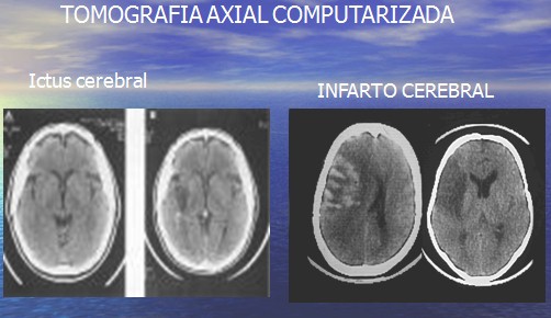 enfermedad_cerebrovascular/ACV_ictus_TAC