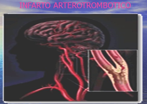 enfermedad_cerebrovascular/ACV_infarto_aterotrombotico