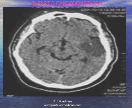 enfermedad_cerebrovascular/ACV_infarto_cardioembolico