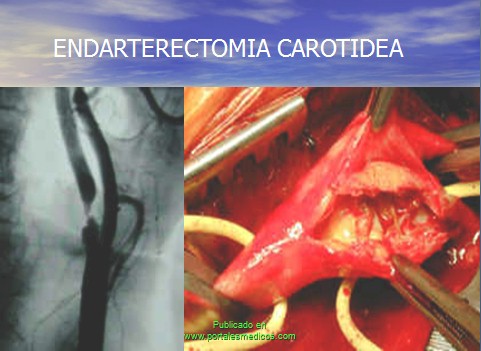 enfermedad_cerebrovascular/ACV_tratamiento_endarterectomia_carotidea