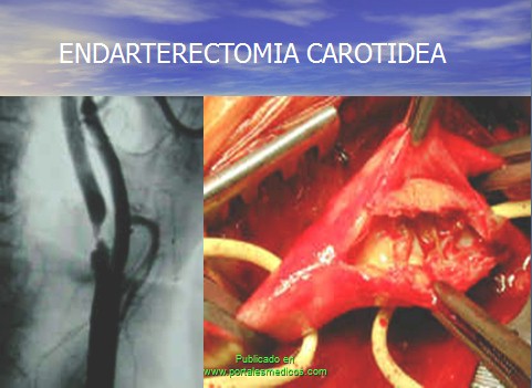 enfermedad_cerebrovascular/ACV_tratamiento_endarterectomia_carotidea enfermedad_cerebrovascular/ACV_tratamiento_endarterectomia_carotidea