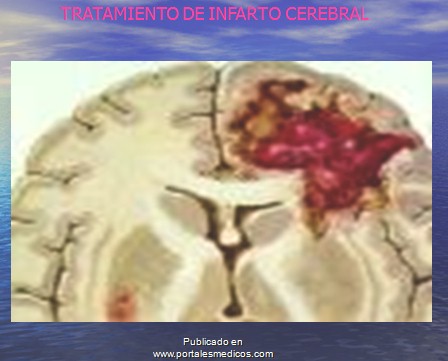enfermedad_cerebrovascular/ACV_tratamiento_infarto_cerebral enfermedad_cerebrovascular/ACV_tratamiento_infarto_cerebral