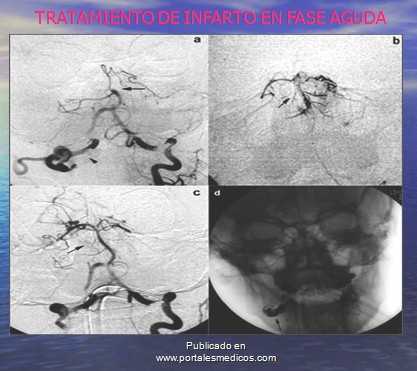 enfermedad_cerebrovascular/ACV_tratamiento_infarto_cerebral_agudo