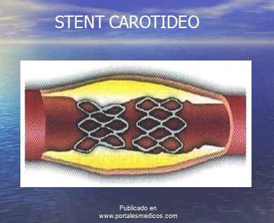 enfermedad_cerebrovascular/ACV_tratamiento_stent_carotideo