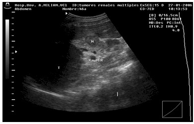 esclerosis_tuberosa_Bourneville/angiomiolipomas_renales_ecografia