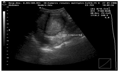 esclerosis_tuberosa_Bourneville/esclerosis_tuberosa_Bourneville_ecografia_renal esclerosis_tuberosa_Bourneville/esclerosis_tuberosa_Bourneville_ecografia_renal