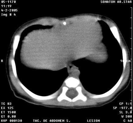hemorragia_suprarrenal_bilateral_neonatal_TAC