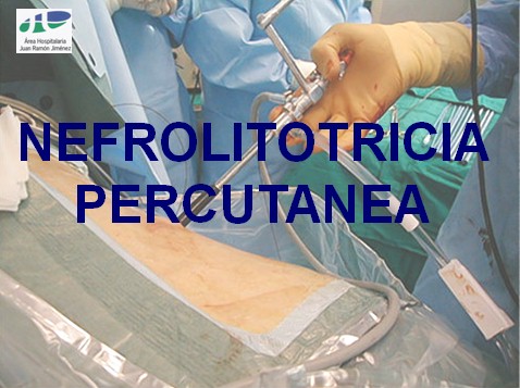 litotricia_percutanea/nefrolitotricia_percutanea_1