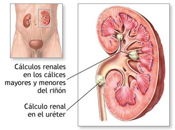 litotricia_percutanea/nefrolitotricia_percutanea_calculos_renales