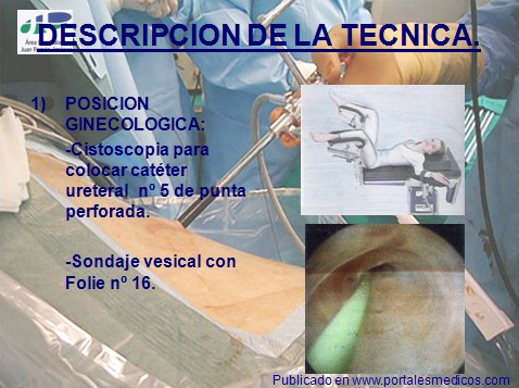 litotricia_percutanea/nefrolitotricia_percutanea_descripcion_tecnica litotricia_percutanea/nefrolitotricia_percutanea_descripcion_tecnica