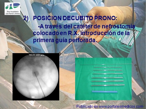 litotricia_percutanea/nefrolitotricia_percutanea_descripcion_tecnica_3 litotricia_percutanea/nefrolitotricia_percutanea_descripcion_tecnica_3