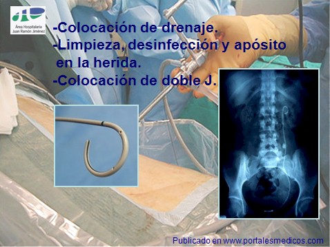 litotricia_percutanea/nefrolitotricia_percutanea_doble_J litotricia_percutanea/nefrolitotricia_percutanea_doble_J