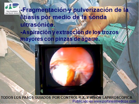 litotricia_percutanea/nefrolitotricia_percutanea_fragmentacion_litiasis litotricia_percutanea/nefrolitotricia_percutanea_fragmentacion_litiasis