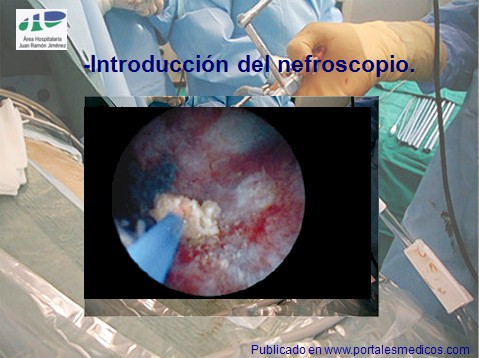 litotricia_percutanea/nefrolitotricia_percutanea_tecnica_nefroscopio litotricia_percutanea/nefrolitotricia_percutanea_tecnica_nefroscopio