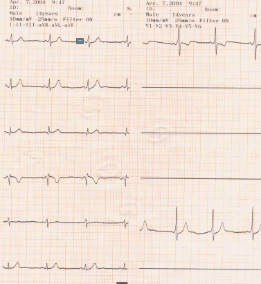 manual_cardiologia_pautas/Wolff_Parkinson_White_WPW