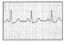 manual_cardiologia_pautas/Wolff_Parkinson_White_WPW_sinusal