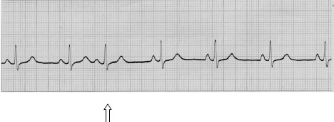 manual_cardiologia_pautas/extrasistole_supraventricular_auricular