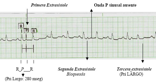 manual_cardiologia_pautas/extrasistole_supraventricular_auricular_2