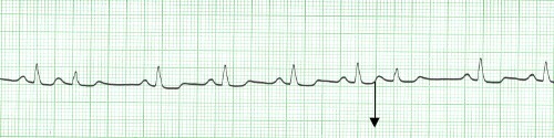 manual_cardiologia_pautas/extrasistole_supraventricular_auricular_3