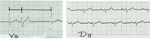 manual_cardiologia_pautas/extrasistole_ventricular_extrasistoles_ventriculares_1