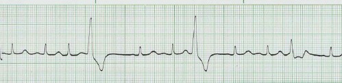 manual_cardiologia_pautas/extrasistole_ventricular_extrasistoles_ventriculares_2