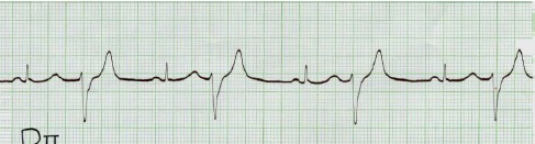 manual_cardiologia_pautas/extrasistole_ventricular_extrasistoles_ventriculares_3