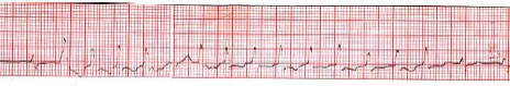 manual_cardiologia_pautas/extrasistole_ventricular_extrasistoles_ventriculares_4