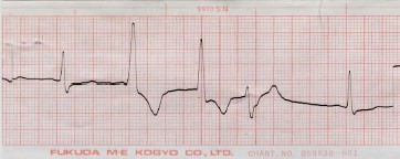 manual_cardiologia_pautas/extrasistole_ventricular_extrasistoles_ventriculares_5