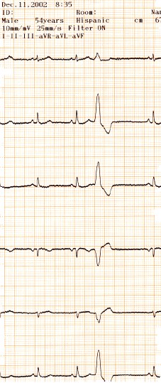 manual_cardiologia_pautas/extrasistole_ventricular_extrasistoles_ventriculares_6