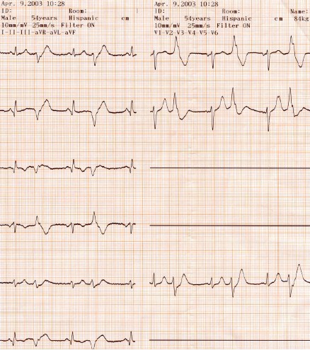 manual_cardiologia_pautas/extrasistole_ventricular_extrasistoles_ventriculares_7