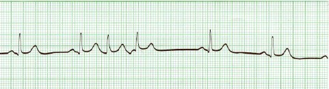 manual_cardiologia_pautas/extrasistoles_supraventriculares_1