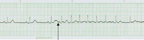 manual_cardiologia_pautas/extrasistoles_supraventriculares_2