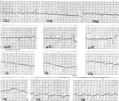 manual_cardiologia_pautas/fibrilacion_auricular_1