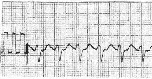 manual_cardiologia_pautas/flutter_auricular_1