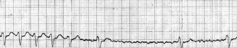 manual_cardiologia_pautas/flutter_auricular_2