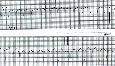 manual_cardiologia_pautas/flutter_auricular_3