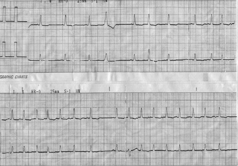 manual_cardiologia_pautas/ritmo_auricular_caotico manual_cardiologia_pautas/ritmo_auricular_caotico