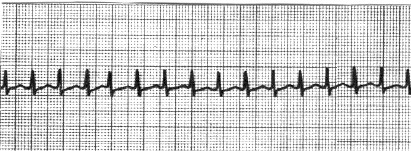 manual_cardiologia_pautas/taquicardia_paroxistica_intranodal_1 manual_cardiologia_pautas/taquicardia_paroxistica_intranodal_1