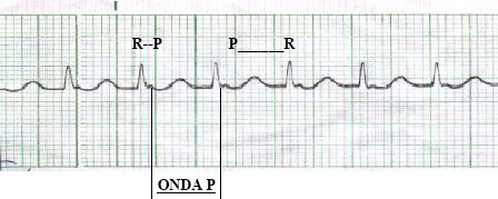 manual_cardiologia_pautas/taquicardia_paroxistica_intranodal_3 manual_cardiologia_pautas/taquicardia_paroxistica_intranodal_3