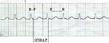 manual_cardiologia_pautas/taquicardia_paroxistica_intranodal_3