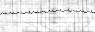 manual_cardiologia_pautas/taquicardia_paroxistica_intranodal_4 manual_cardiologia_pautas/taquicardia_paroxistica_intranodal_4